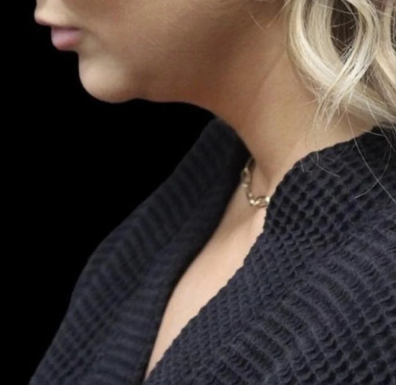 Submental Liposuction Before & After Gallery - Patient 234480 - Image 3