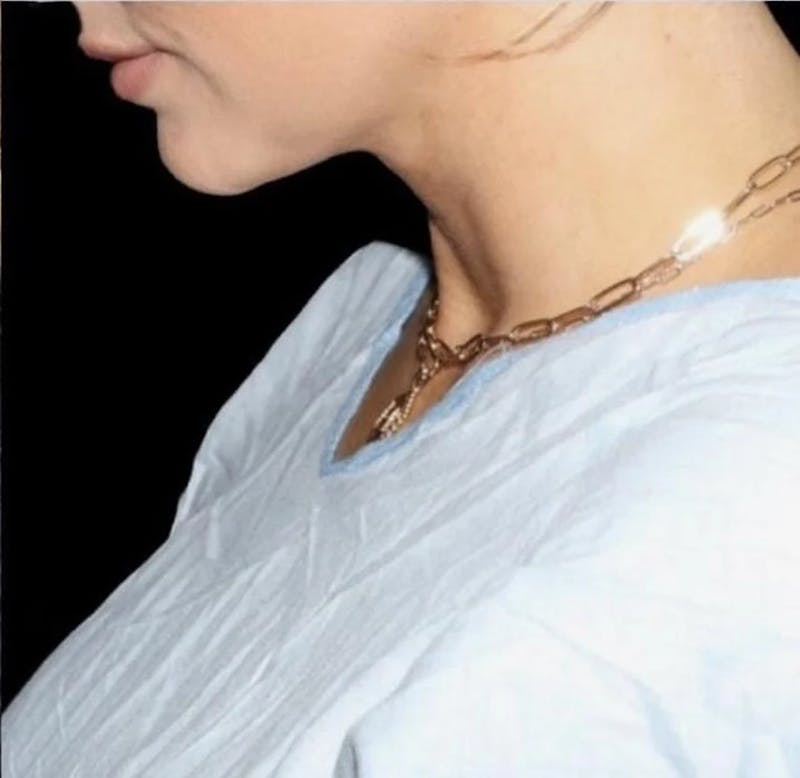 Submental Liposuction Before & After Gallery - Patient 234480 - Image 4