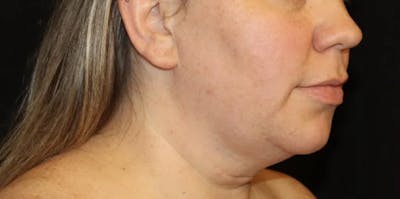 Submental Liposuction Before & After Gallery - Patient 894207 - Image 1