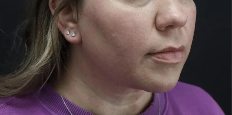 Submental Liposuction Before & After Gallery - Patient 894207 - Image 2