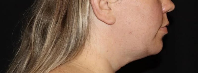 Submental Liposuction Before & After Gallery - Patient 894207 - Image 3