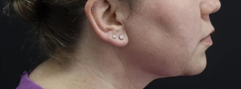 Submental Liposuction Before & After Gallery - Patient 894207 - Image 4