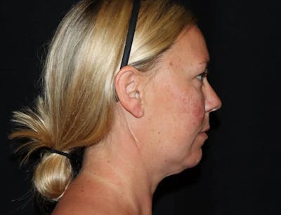 Submental Liposuction Before & After Gallery - Patient 782366 - Image 1