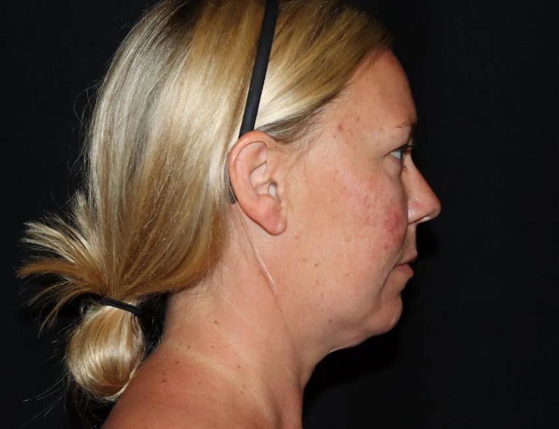 Submental Liposuction Before & After Gallery - Patient 782366 - Image 1