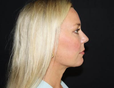 Submental Liposuction Before & After Gallery - Patient 782366 - Image 2