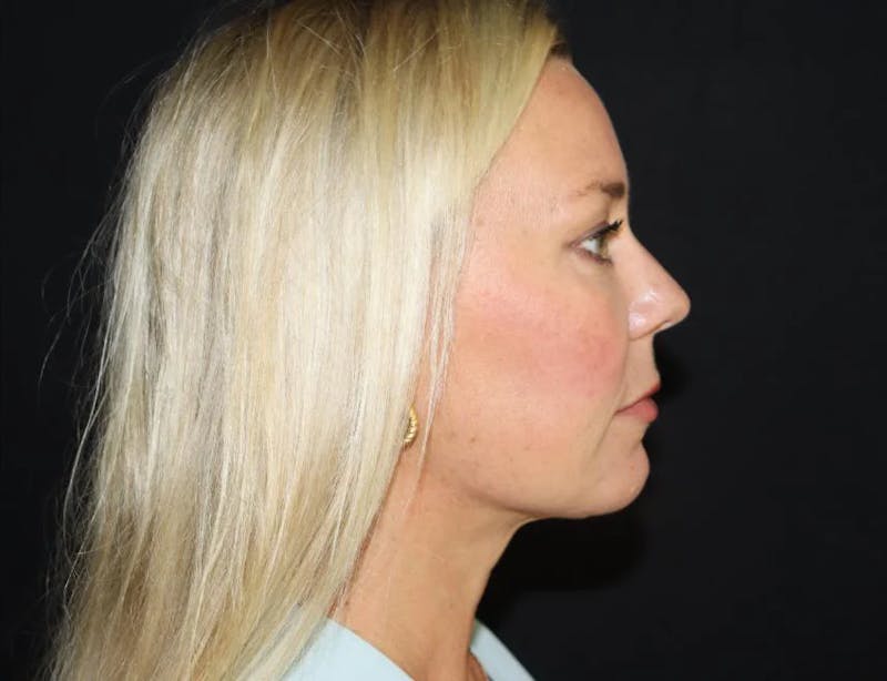 Submental Liposuction Before & After Gallery - Patient 782366 - Image 2