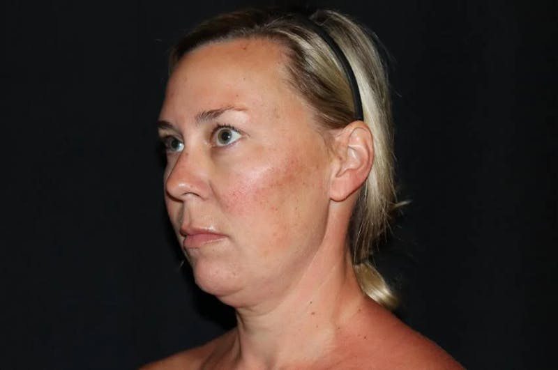 Submental Liposuction Before & After Gallery - Patient 782366 - Image 3