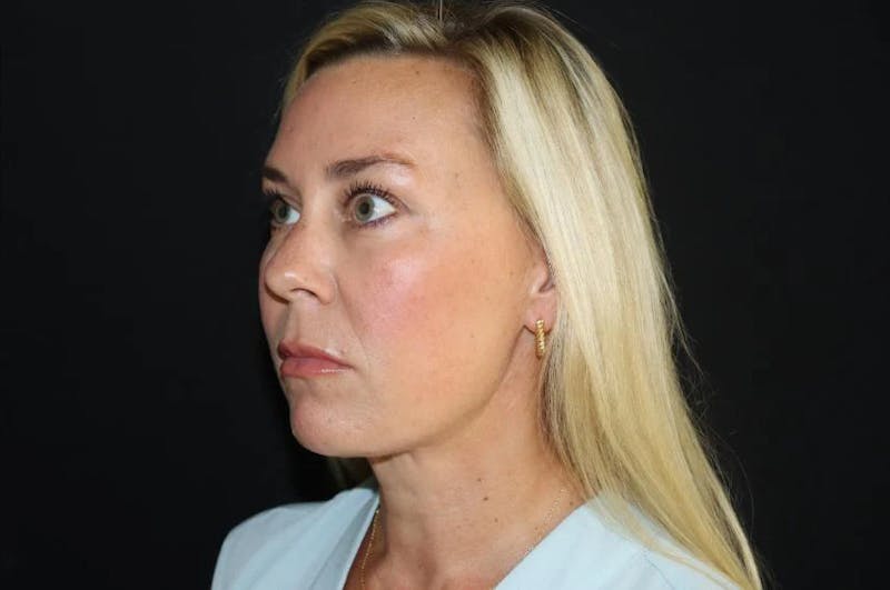 Submental Liposuction Before & After Gallery - Patient 782366 - Image 4