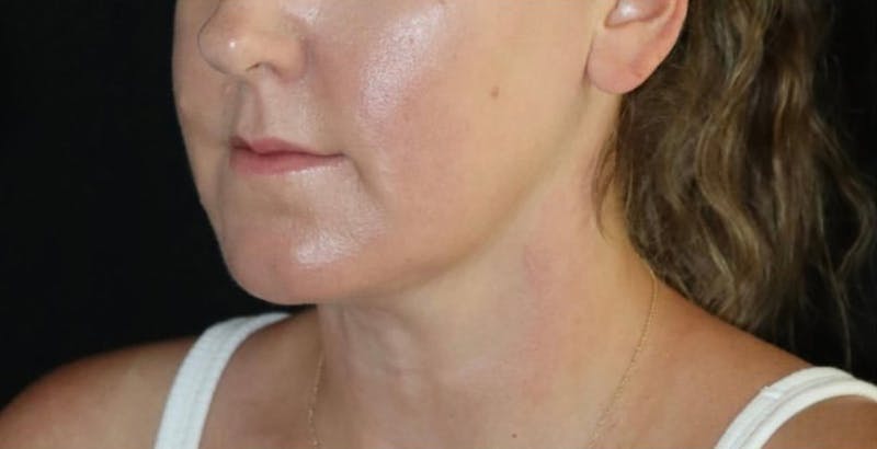 Submental Liposuction Before & After Gallery - Patient 673239 - Image 2