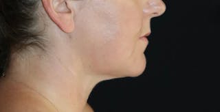 Submental Liposuction Before & After Gallery - Patient 673239 - Image 4