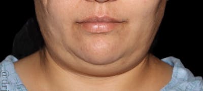 Submental Liposuction Before & After Gallery - Patient 139945 - Image 1