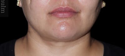 Submental Liposuction Before & After Gallery - Patient 139945 - Image 2