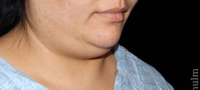 Submental Liposuction Before & After Gallery - Patient 139945 - Image 3