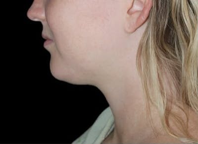 Submental Liposuction Before & After Gallery - Patient 370552 - Image 1