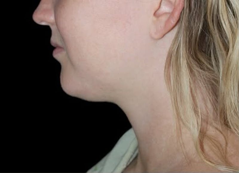 Submental Liposuction Before & After Gallery - Patient 370552 - Image 1