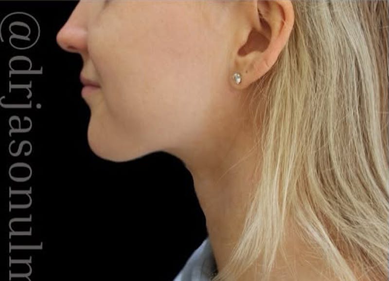 Submental Liposuction Before & After Gallery - Patient 370552 - Image 3