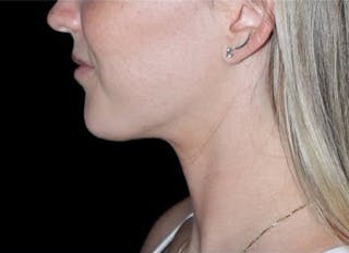 Submental Liposuction Before & After Gallery - Patient 370552 - Image 4