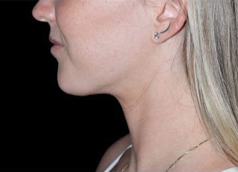 Submental Liposuction Before & After Gallery - Patient 370552 - Image 4