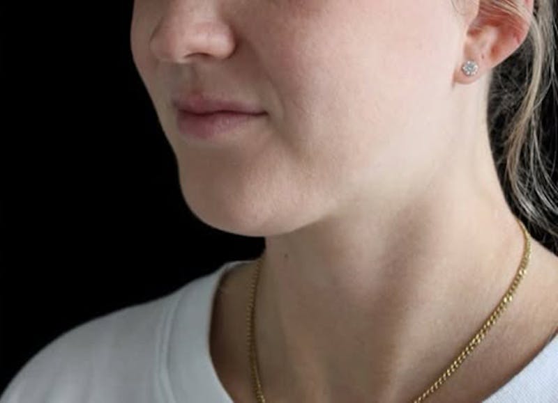 Submental Liposuction Before & After Gallery - Patient 370552 - Image 5