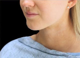 Submental Liposuction Before & After Gallery - Patient 370552 - Image 6