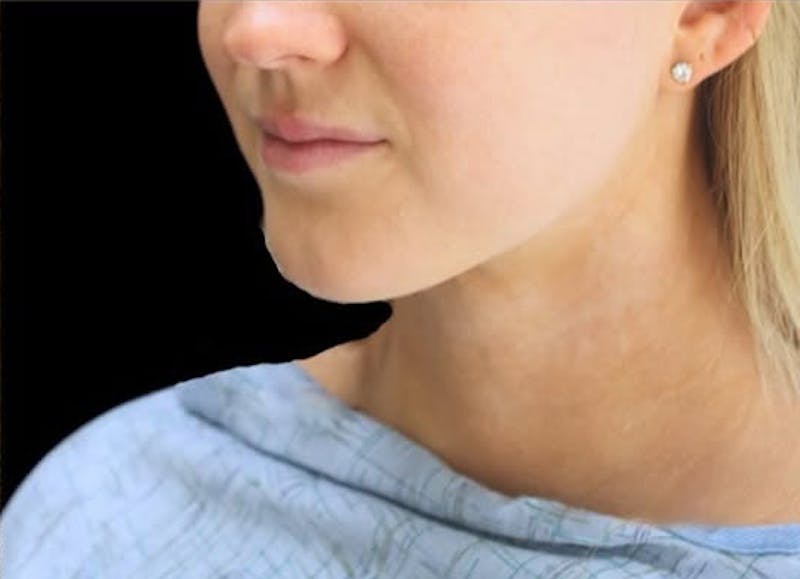 Submental Liposuction Before & After Gallery - Patient 370552 - Image 7