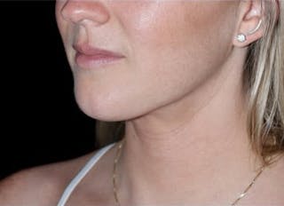 Submental Liposuction Before & After Gallery - Patient 370552 - Image 8