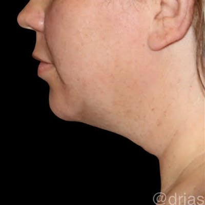 Submental Liposuction Before & After Gallery - Patient 690744 - Image 1