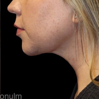 Submental Liposuction Before & After Gallery - Patient 690744 - Image 2