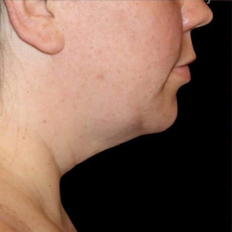Submental Liposuction Before & After Gallery - Patient 690744 - Image 3