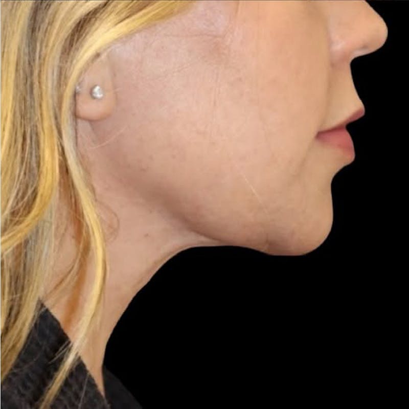Submental Liposuction Before & After Gallery - Patient 690744 - Image 4