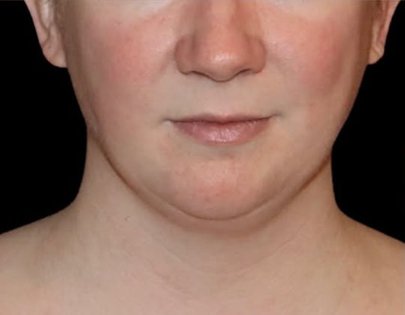 Submental Liposuction Before & After Gallery - Patient 696253 - Image 1