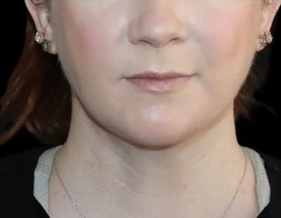 Submental Liposuction Before & After Gallery - Patient 696253 - Image 2