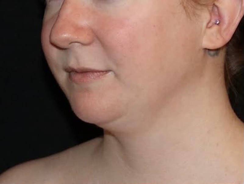 Submental Liposuction Before & After Gallery - Patient 696253 - Image 3