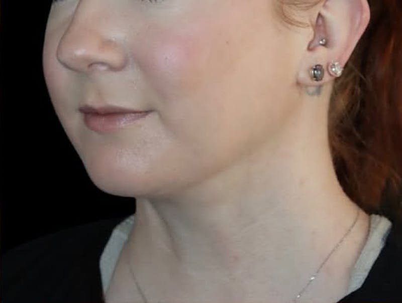 Submental Liposuction Before & After Gallery - Patient 696253 - Image 4