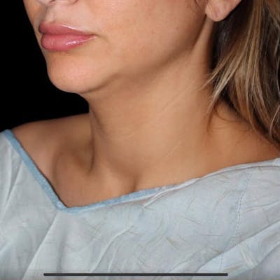 Submental Liposuction Before & After Gallery - Patient 409985 - Image 1