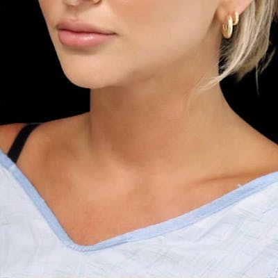 Submental Liposuction Before & After Gallery - Patient 409985 - Image 2