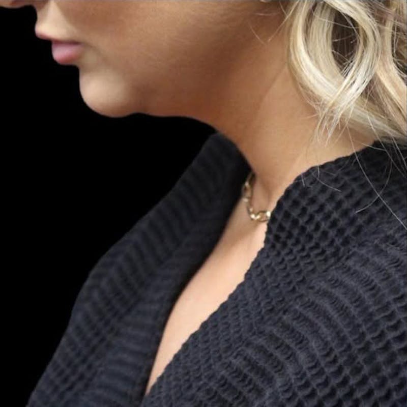 Submental Liposuction Before & After Gallery - Patient 409985 - Image 3