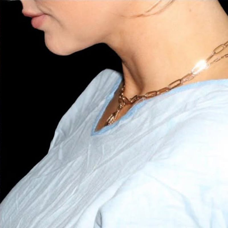 Submental Liposuction Before & After Gallery - Patient 409985 - Image 4