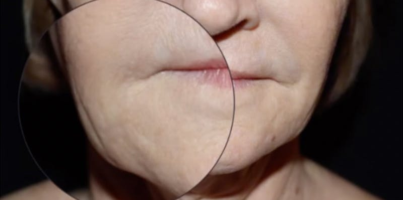 Lip lift Before & After Gallery - Patient 124843 - Image 1