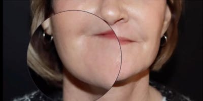 Lip lift Before & After Gallery - Patient 124843 - Image 2