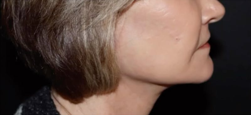 Lip lift Before & After Gallery - Patient 124843 - Image 4