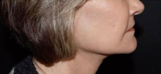 Lip lift Before & After Gallery - Patient 124843 - Image 4