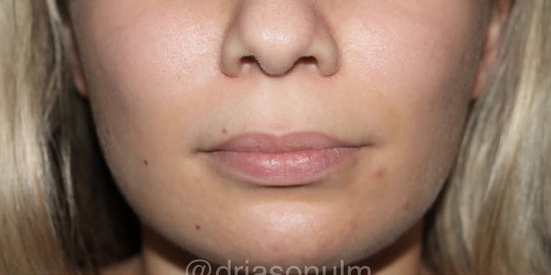 Lip lift Before & After Gallery - Patient 183540 - Image 1