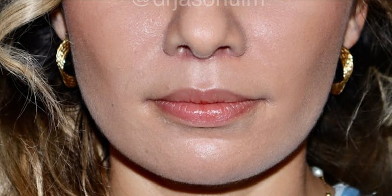 Lip lift Before & After Gallery - Patient 183540 - Image 2
