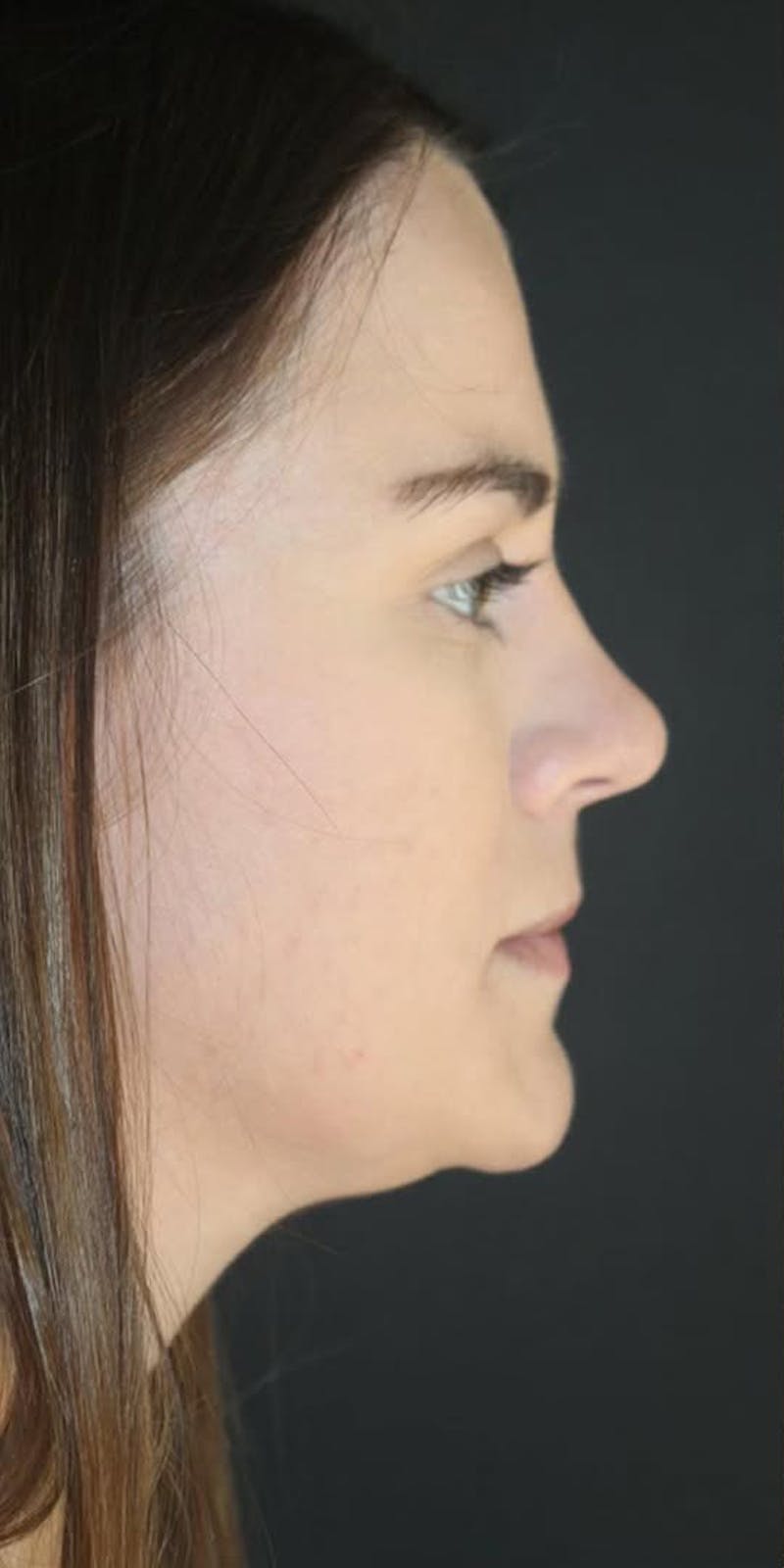 Juvederm Volbella Before & After Gallery - Patient 534087 - Image 1