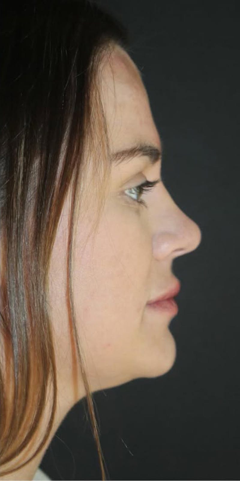 Juvederm Volbella Before & After Gallery - Patient 534087 - Image 2