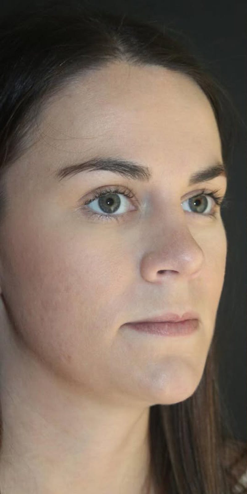 Juvederm Volbella Before & After Gallery - Patient 534087 - Image 3