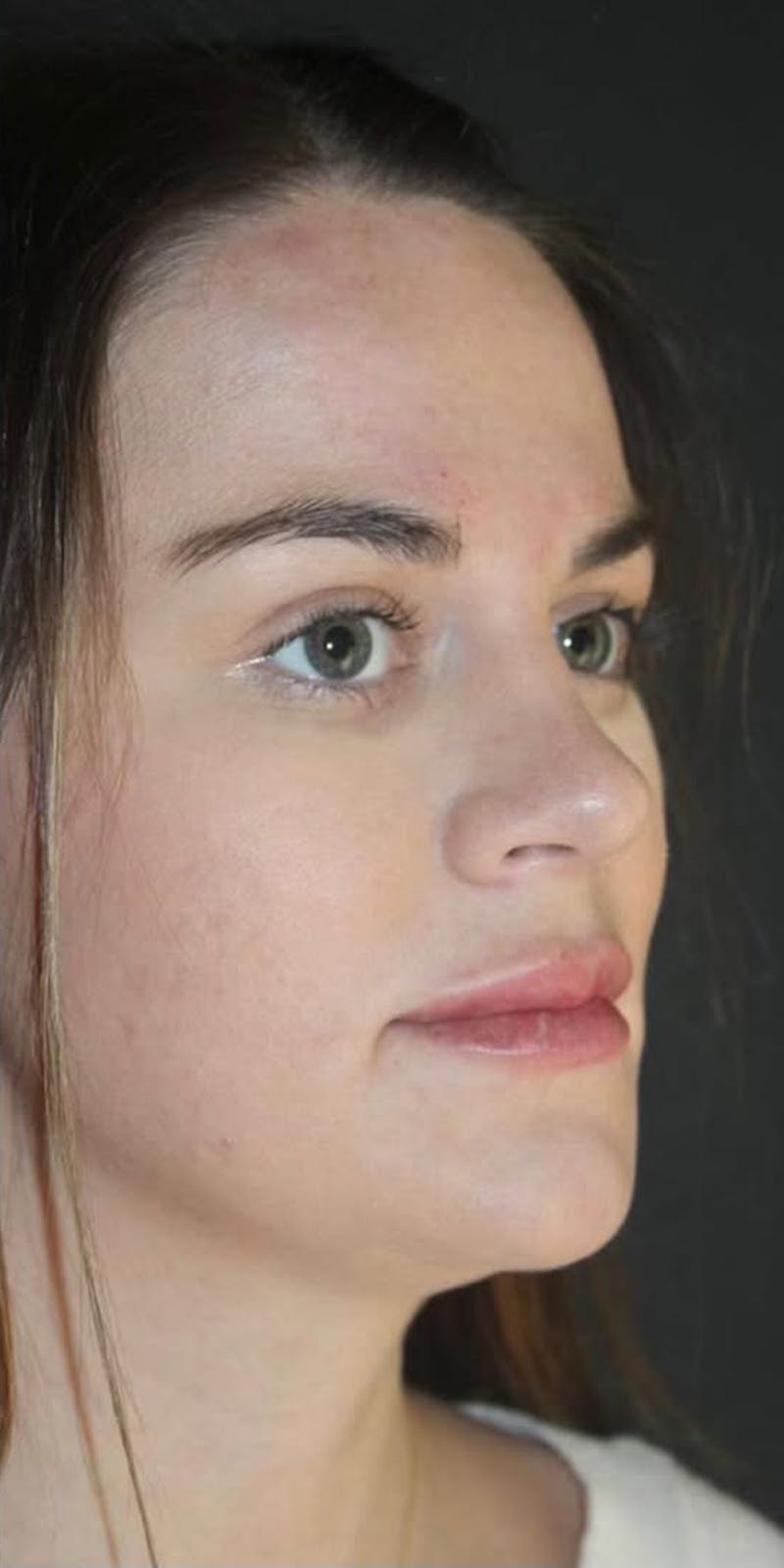 Juvederm Volbella Before & After Gallery - Patient 534087 - Image 4