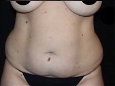 Mommy Makeover Before & After Gallery - Patient 183157 - Image 1