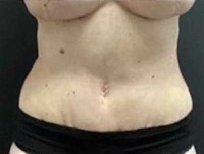 Mommy Makeover Before & After Gallery - Patient 183157 - Image 2